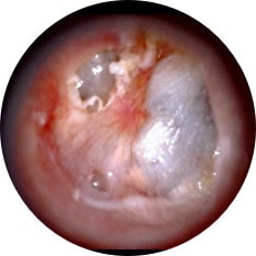 Cholesteatoma image taken with hearScope example 3