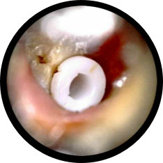Grommets image taken with hearScope example 1