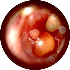 Accute Otitis Media image taken with hearScope example 1