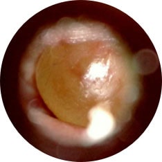 Accute Otitis Media image taken with hearScope example 2