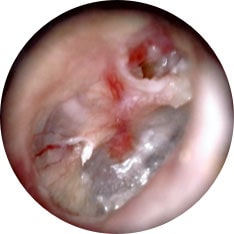 Cholesteatoma image taken with hearScope example 1