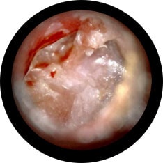 Cholesteatoma image taken with hearScope example 2