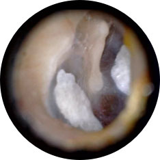 Myringosclerosis image taken with hearScope example 1