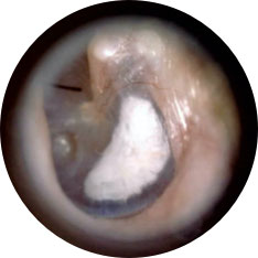Myringosclerosis image taken with hearScope example 2