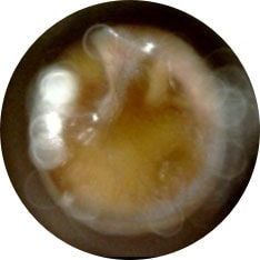 Otitis Media with effusion image taken with hearScope example 1