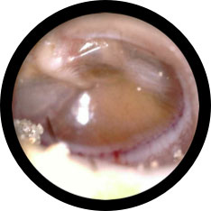 Otitis Media with effusion image taken with hearScope example 2