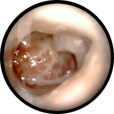 Wet chronic perforation image taken with hearScope example 1