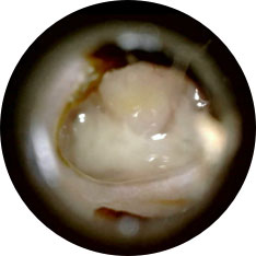 Wet chronic perforation image taken with hearScope example 2