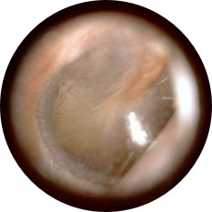Normal tympanic membrane image taken with hearScope example 1