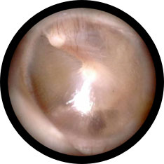 Normal tympanic membrane image taken with hearScope example 2